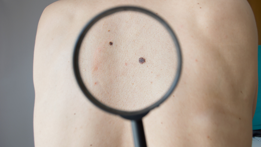 Hudtumörer är idag den näst vanligaste maligna cancerformen i Sverige för bägge könen och det fortsätter att öka. Foto: Shutterstock